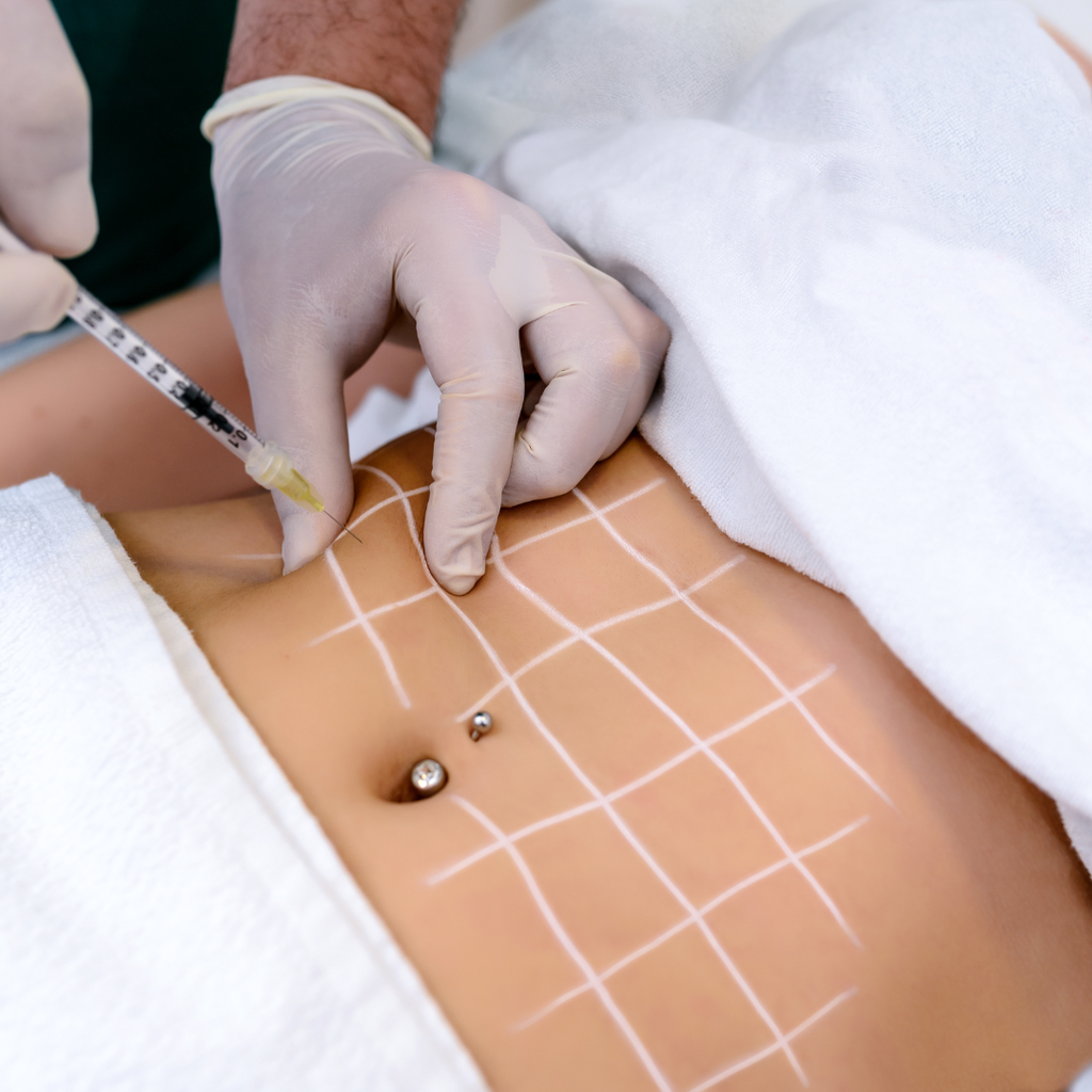 Mesoterapia