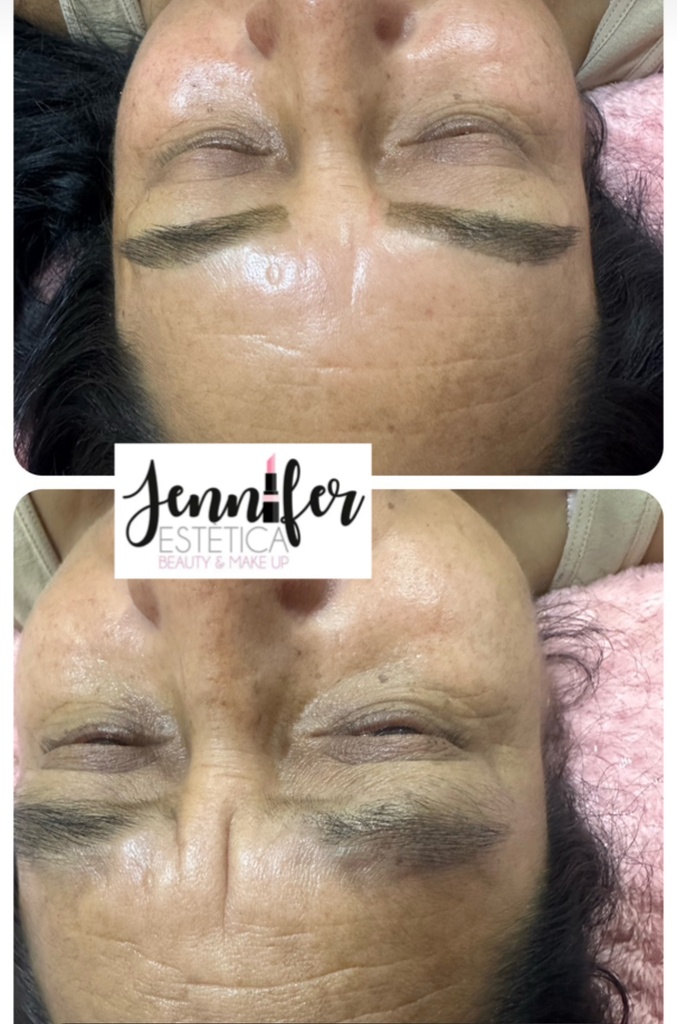 Peeling Queratoplastico