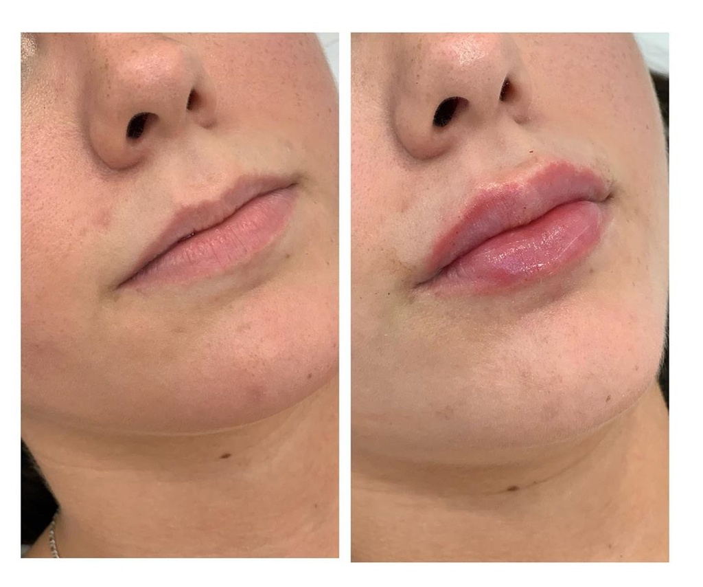 Aumento Labial Con Ácido Hialurónico No Reticulado