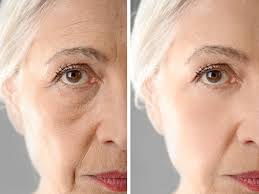 Rejuvenecimiento Facial