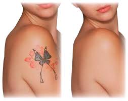 Eliminación Tatuajes